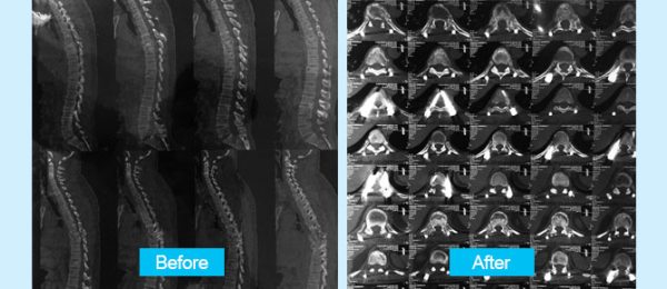 thoracolumbar-spine-trauma-en