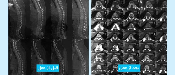 thoracolumbar-spine-trauma-fa