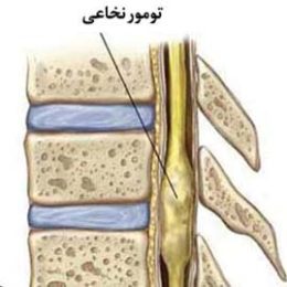 تومور نخاعی اپاندیموما