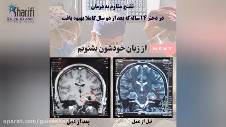 تشنج مقاوم به درمان