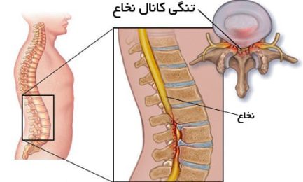 علائم تنگی کانال نخاعی