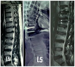دیسک توراسیک