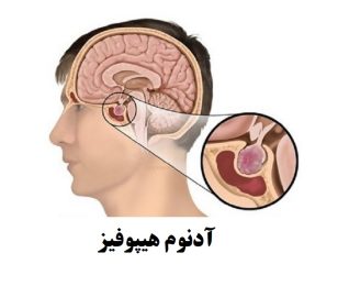 تومور هیپوفیز آدنوم