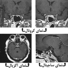 کوشینگ بعد از عمل