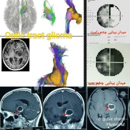 تومور گلیوم